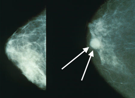 乳がんのマンモグラフィー像