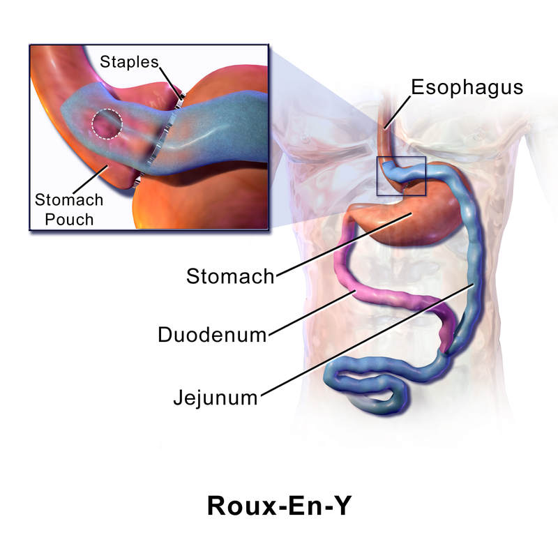 Roux-En-Y手術