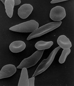 鎌状および通常赤血球の電子顕微鏡写真
