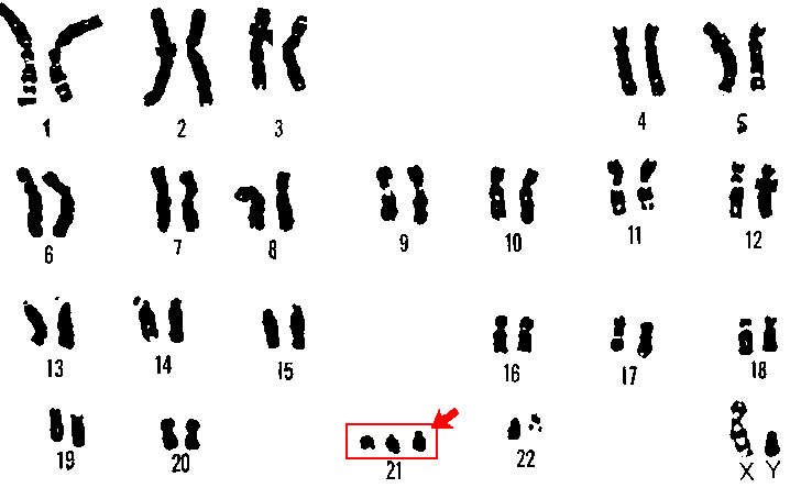 21番染色体 (ヒト)