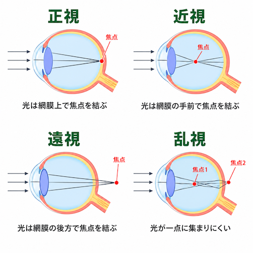 近視、遠視、乱視のメカニズム