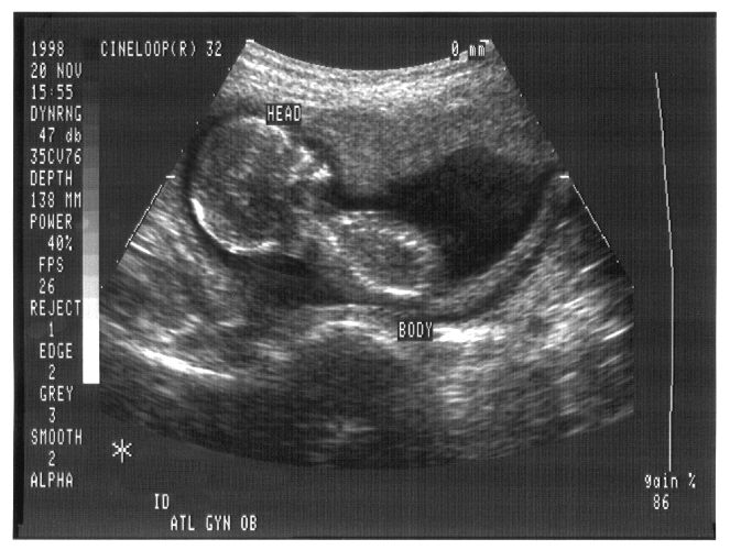 超音波診断 赤ちゃん 画像